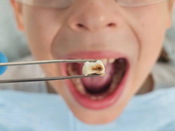 Best Emergency Root Canal Treatment in Herndon, VA